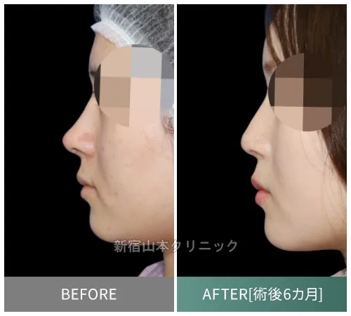 高すぎた鼻先を低くする