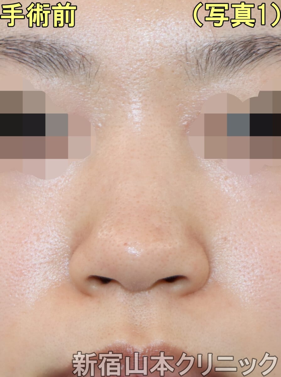 鼻尖修正（鼻先を違和感のない自然な形で細くする） | 症例写真・ビフォー アフター画像の紹介 | 池袋の美容皮膚科・美容外科なら「みずほクリニック」