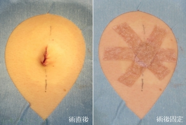 手術直後の状態（写真17）と手術後の固定（写真18）