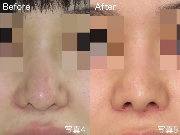 術前（写真4）と術後（写真5）では、鼻の穴の形と小鼻の雰囲気が変わったのがお分かり頂けると思います。