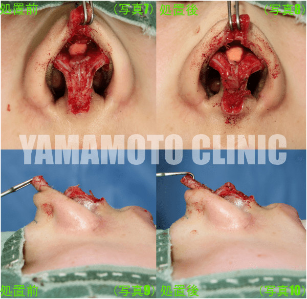 鼻先・処置前（写真7）鼻先・処置後（写真8） 内部・処置前（写真9）内部・処置後（写真10）