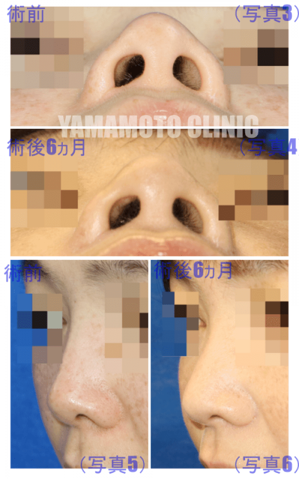 術前・下（写真3）術後6ヵ月・下（写真4） 術前・斜め（写真5）術後6ヵ月・斜め（写真6）  さらに、下から見上げた状態では、鼻尖の変化は少なく、シリコン（プロテーゼ）を抜いたにもかかわらず、低くなっていないのが、分かりやすいのではないでしょうか（写真3, 4）。  また、鼻先（鼻尖）の形状としては、若干すっきりしたように仕上がっていて、斜めの方向から見て頂くと、その変