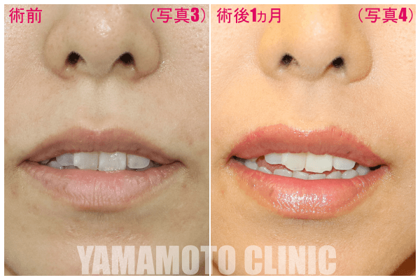 術前（写真3）術後1ヵ月（写真4）  口を若干開いた状態（写真3, 4）