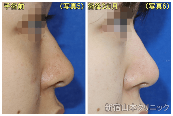  横顔で比較（写真5, 6）して頂くと、鼻先が若干細く高くなっているものの、大きな変化ではないことが認識できるかと思われます。