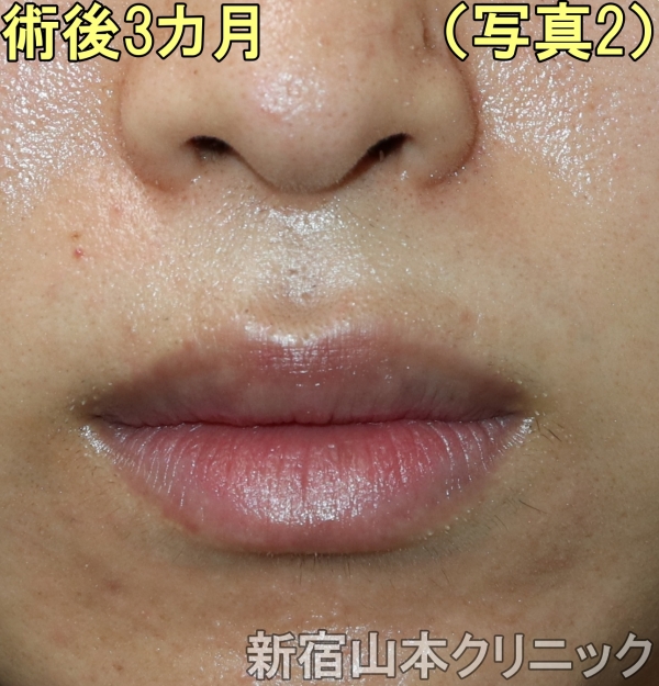 上口唇縮小術 唇を小さくする 唇を薄くする手術とは 美容外科話 美容外科 美容整形修正の名医は東京新宿の山本クリニック